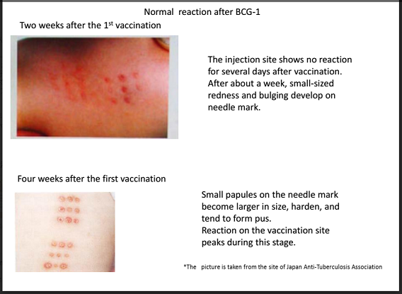 Image result for bcg vaccination effects
